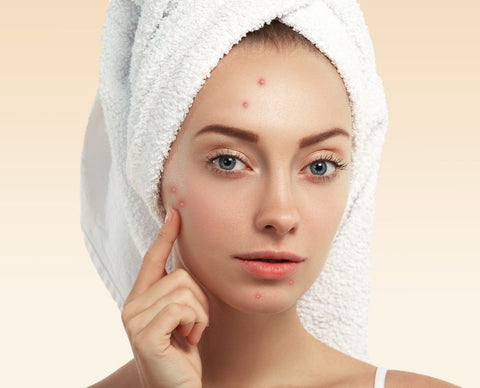 acne prone